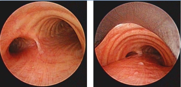 Asymmetry of the two mainstem bronchi