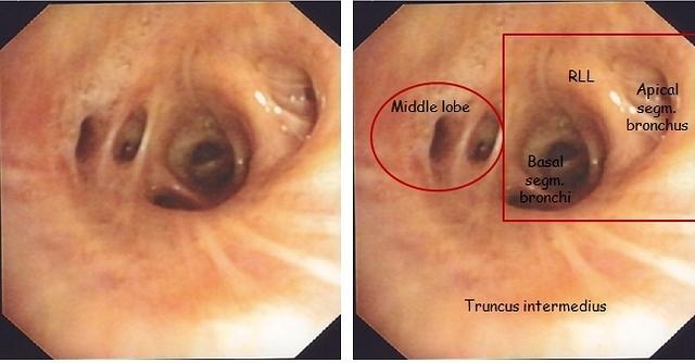 Anatomical variation of the middle lobe bronchus