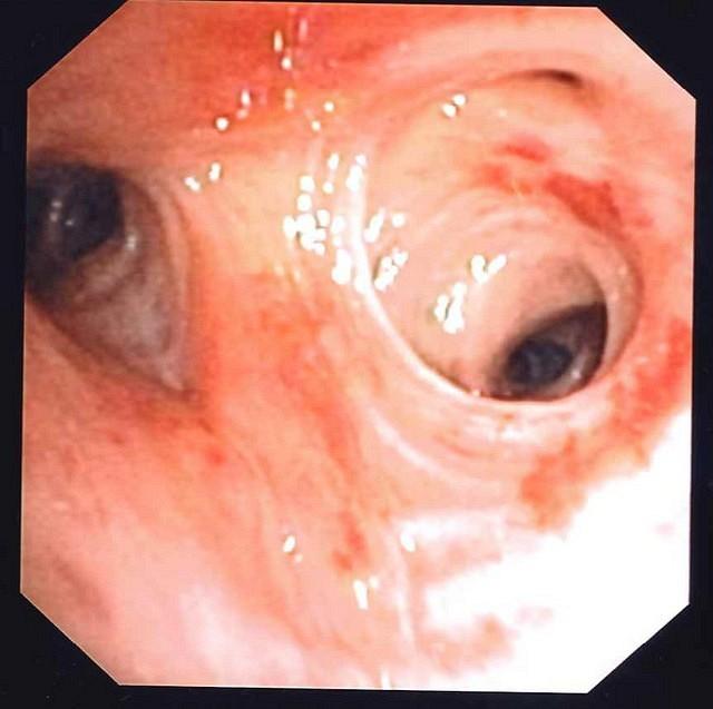 Anatomic variation of the right upper lobe bronchus