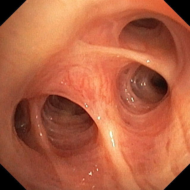 Quadrifurcation of the right upper lobe bronchus