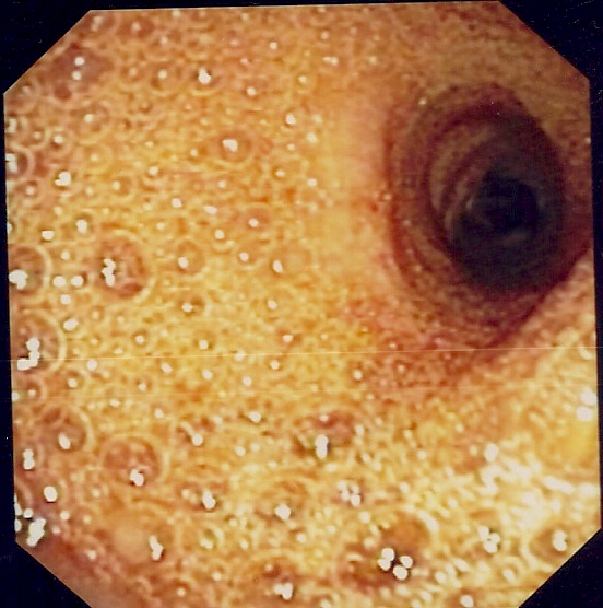 Foamy secretions
