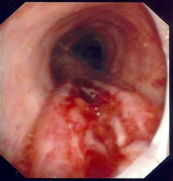 Blood clot