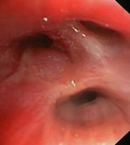 Congestive mucosa of the RUL