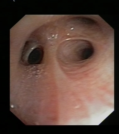 Normal Mucosa