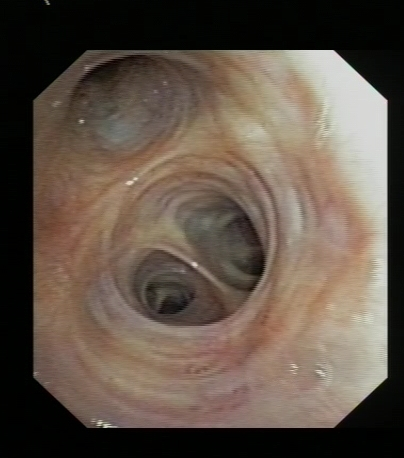 Normal Mucosa