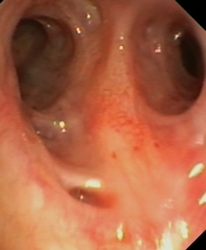 Dilated bronchial gland orifice