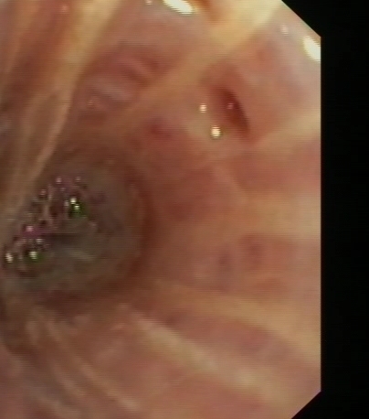 Dilated bronchial gland orifice