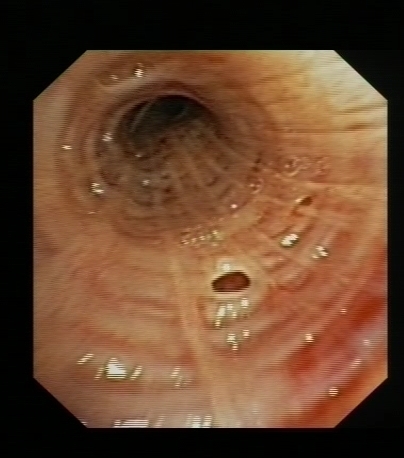 Dilated bronchial gland orifice