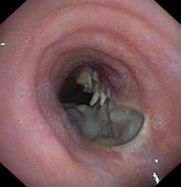 Tracheoesophageal fistula