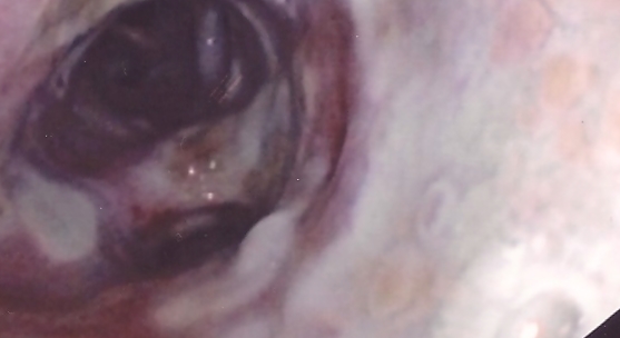 White friable membranes and apthoid-looking lesions