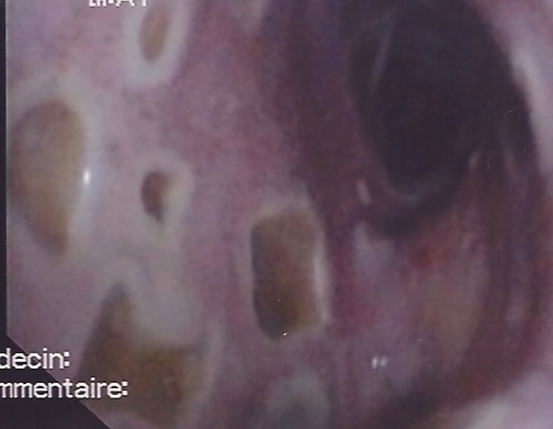 Multiple mucosal ulcers