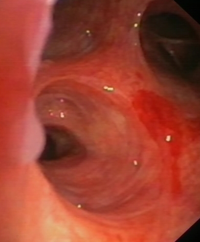 Vesicle lesions (and bronchial ulcer)