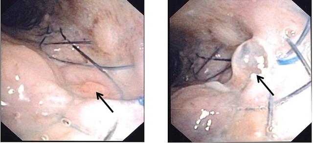 Perforation of the bronchial wall