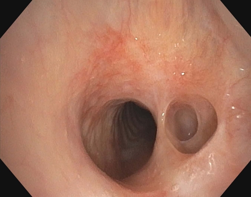 Tracheal diverticulum