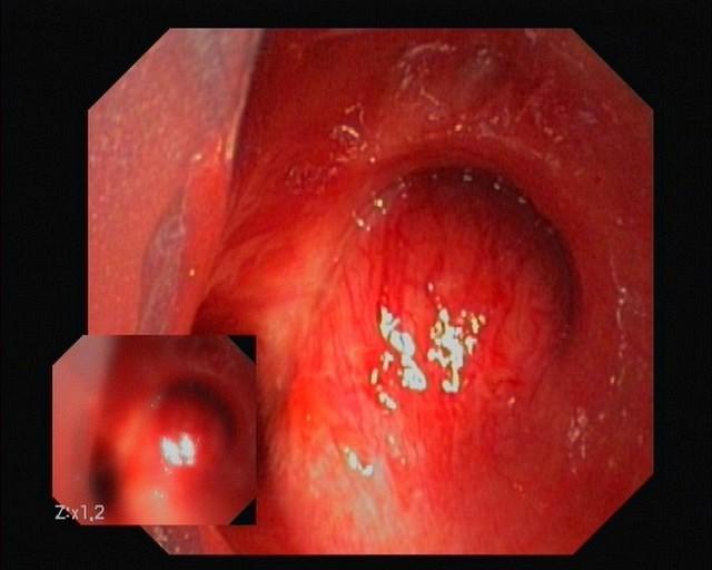 Raised, smooth, shiny and erythematous mucosa