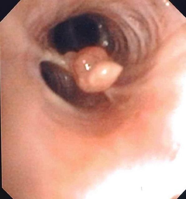 Polypoid exophytic lesion