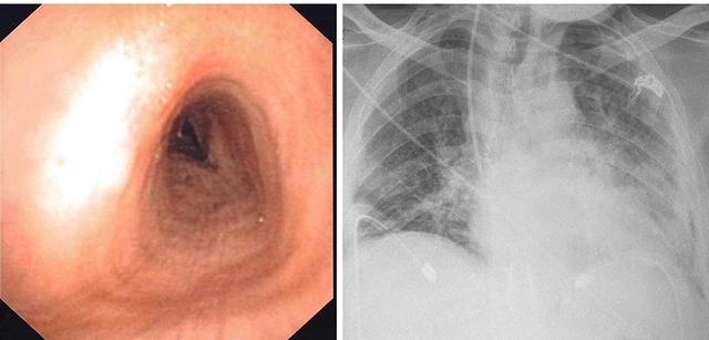 Tracheal deviation