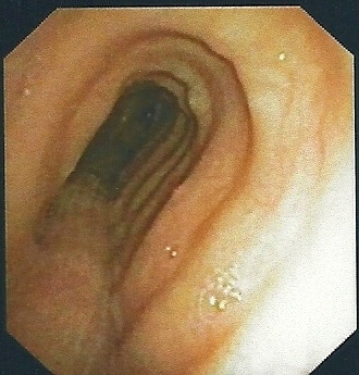 Saber-sheath trachea