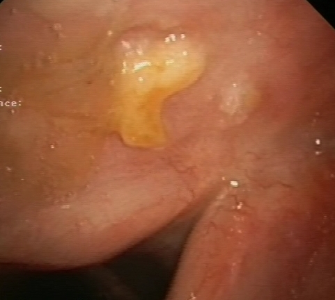 Nodular lesion covered with fibrin