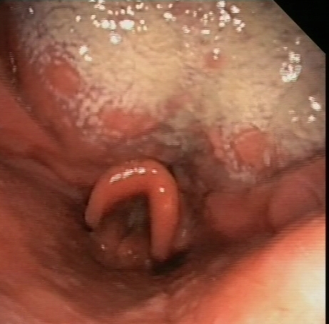 Multiple confluent white patches (white-fleck appearance)