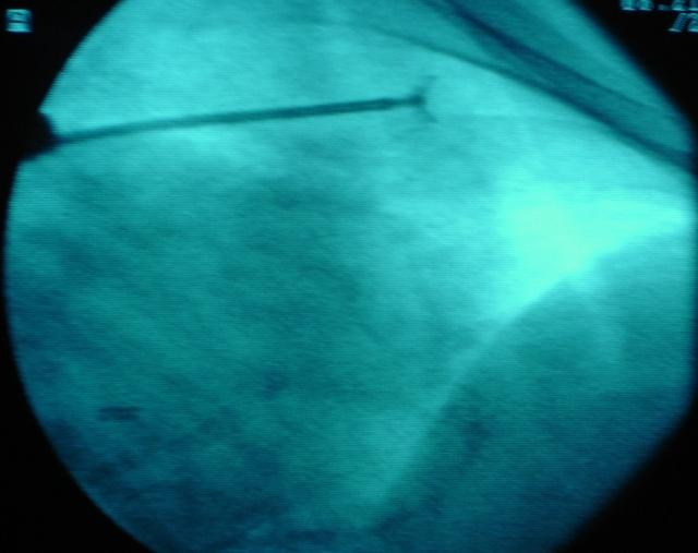 BTB: the forceps is withdrawn, the jaws are opened  and then they are advanced to obtain the sample.