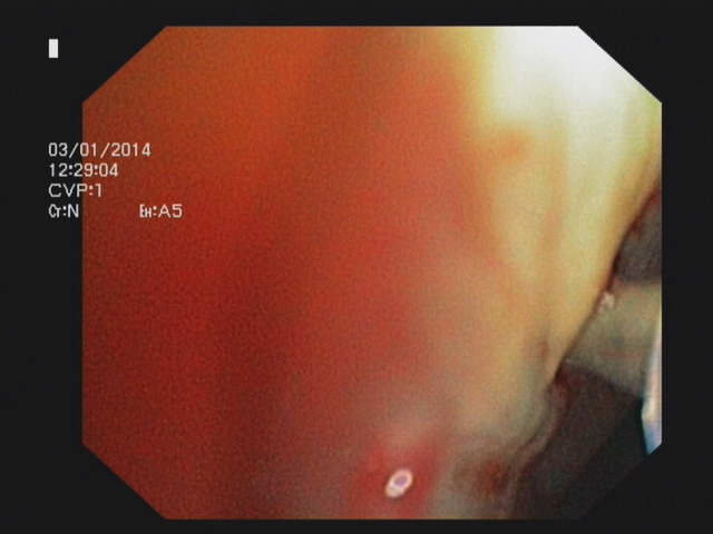 Transbronchial aspiration