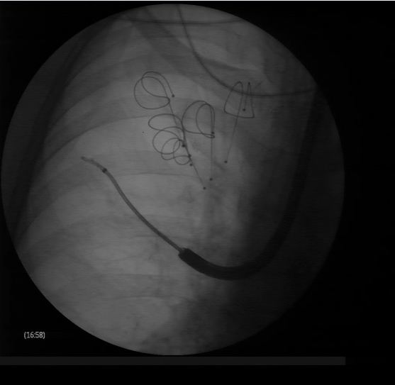Lung volume reduction with coils: the guidewire is advanced to the targeted area