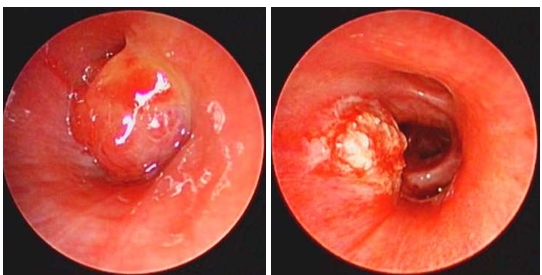 Diathermy resection of an endobronchial carcinoid