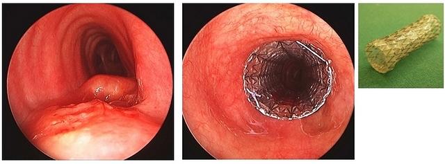 Coated auto-expandible tracheal stent