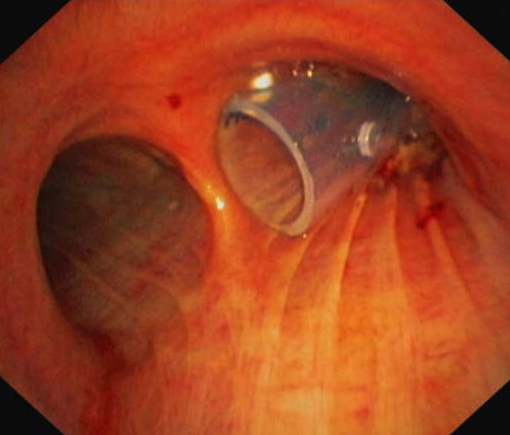 OKI stent placed in the right mainstem bronchus