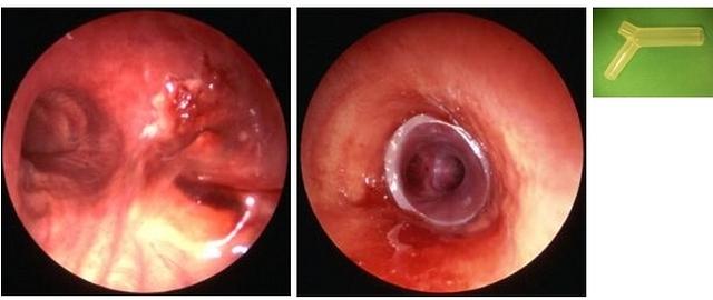 Silicone Stent