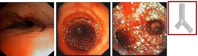 Y shaped tracheobronchial stent