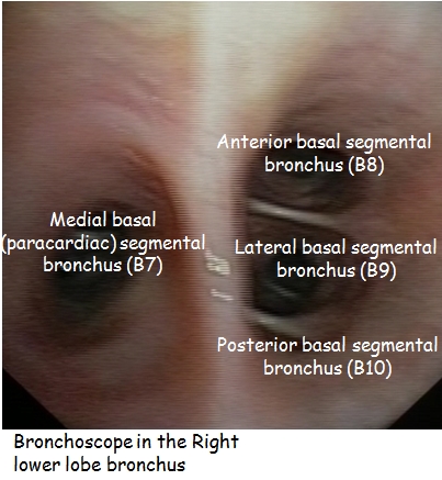 Right basal segmental bronchi