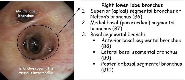 Right lower lobe brochus- annotations