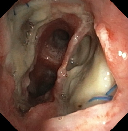 Dehiscence of the left anastomosis
