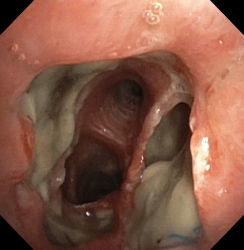 Necrosis of the left anastomosis