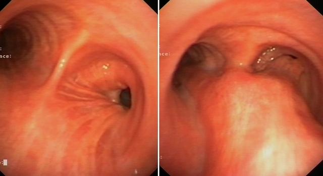 Excessive dynamic airway collapse (trachea, mainstem bronchi) and bronchomalacia (right anastomosis)