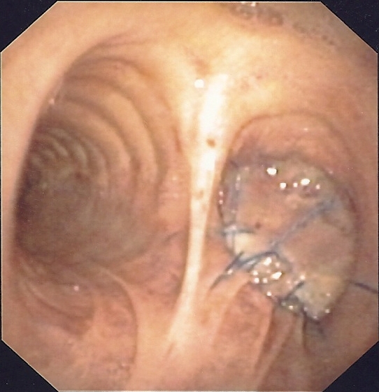 Bronchoplasty (muscle flap): right pneumonectomy