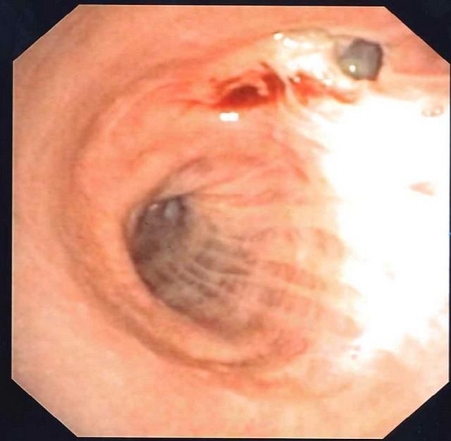 Dehiscence of RUL bronchial stump