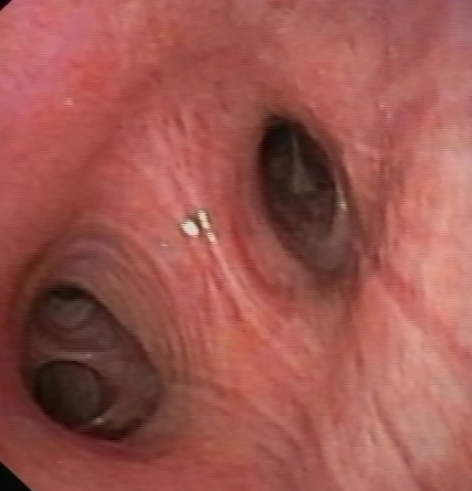 Sleeve resection of the Middle lobe and the RUL