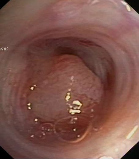 Adenocarcinoma