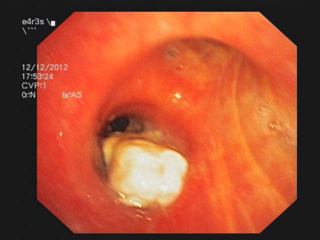 Endobronchial lymphoma of the truncus intermedius