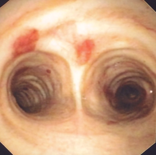 Kaposi's sarcoma of the distal trachea