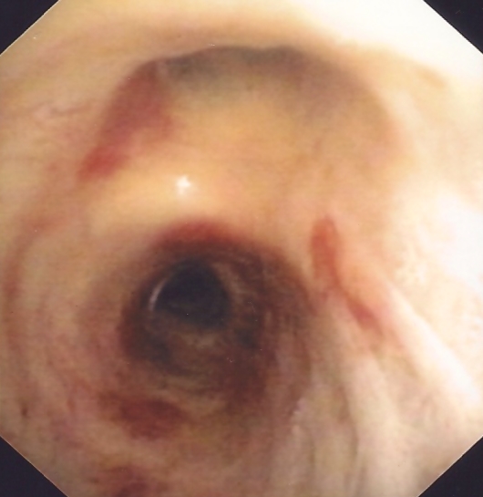 Kaposi's sarcoma of the truncus intermedius and RUL