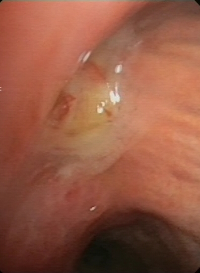 Epidermoid carcinoma RUL