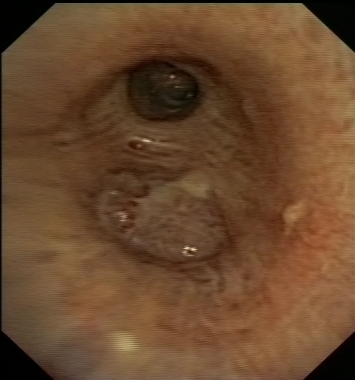 Squamous cell (epidermoid) carcinoma