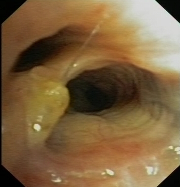 In situ epidermoid carcinoma