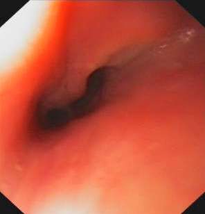 Endobronchial visualisation of the fistula