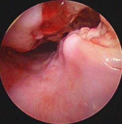 Oesophageal visualisation of the fistula