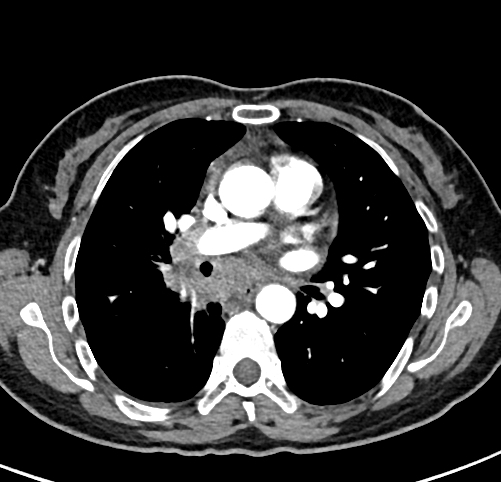 Lymphadenopathy, TB